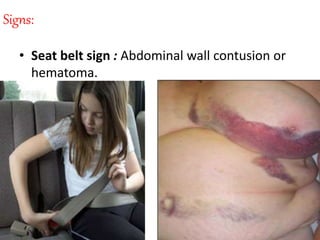 Signs:
• Seat belt sign : Abdominal wall contusion or
hematoma.
 