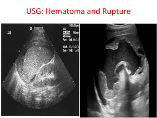 USG: Hematoma and Rupture
 