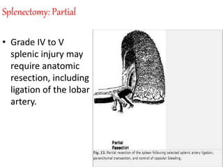 Splenectomy: Partial
• Grade IV to V
splenic injury may
require anatomic
resection, including
ligation of the lobar
artery.
 