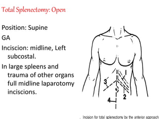 Total Splenectomy: Open
Position: Supine
GA
Inciscion: midline, Left
subcostal.
In large spleens and
trauma of other organs
full midline laparotomy
inciscions.
 