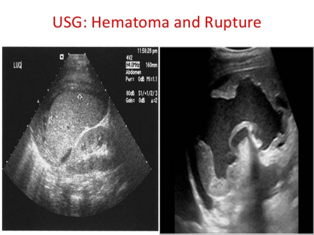 splenic flexture sy drome splenic flexture sy drome