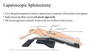 Laparoscopic Splenectomy
• LS is the gold standard for elective splenectomy in patients with normal-sized spleens.
• Right lateral decubitus position(Lateral Approach)
• The lateral approach routinely involves the use of three or four trocars
 