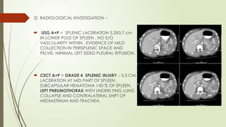 SPLENIC LACERATION MANAGEMENT IN 3 CASES | PPTX