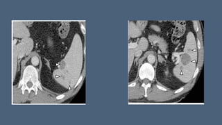 splenic lesions and findings of ct and usg | PPTX