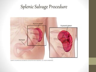 Splenic Salvage Procedure
 
