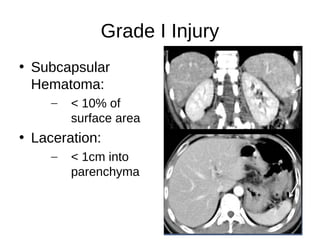 Grade I Injury
• Subcapsular
Hematoma:
– < 10% of
surface area
• Laceration:
– < 1cm into
parenchyma
 