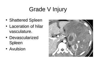 Grade V Injury
• Shattered Spleen
• Laceration of hilar
vasculature.
• Devascularized
Spleen
• Avulsion
 