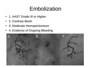 Embolization
• 1. AAST Grade III or Higher
• 2. Contrast Blush
• 3. Moderate Hemoperitoneum
• 4. Evidence of Ongoing Bleeding
 