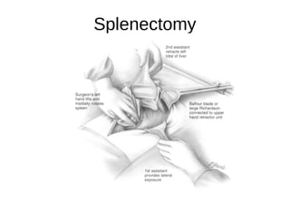 Splenectomy
 