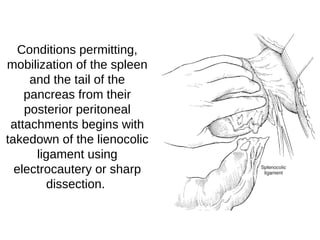 Conditions permitting,
mobilization of the spleen
and the tail of the
pancreas from their
posterior peritoneal
attachments begins with
takedown of the lienocolic
ligament using
electrocautery or sharp
dissection.
 