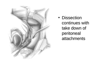 • Dissection
continues with
take down of
peritoneal
attachments
 