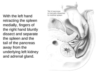 With the left hand
retracting the spleen
medially, fingers of
the right hand bluntly
dissect and separate
the spleen and the
tail of the pancreas
away from the
underlying left kidney
and adrenal gland.
 