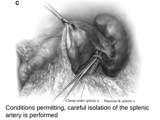Conditions permitting, careful isolation of the splenic
artery is performed
 
