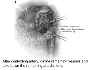 After controlling artery, define remaining vessels and
take down the remaining attachments
 