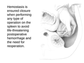 Hemostasis is
ensured closure
when performing
any type of
operation on the
spleen to avoid
life-threatening
postoperative
hemorrhage and
the need for
reoperation.
 