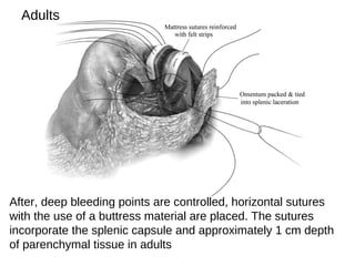 After, deep bleeding points are controlled, horizontal sutures
with the use of a buttress material are placed. The sutures
incorporate the splenic capsule and approximately 1 cm depth
of parenchymal tissue in adults
Adults
 