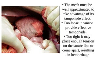 ●
The mesh must be
well approximated to
take advantage of its
tamponade effect.
●
Too loose it cannot
provide effective
tamponade.
●
Too tight it may
place enough tension
on the suture line to
come apart, resulting
in hemorrhage
 
