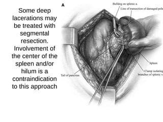 Some deep
lacerations may
be treated with
segmental
resection.
Involvement of
the center of the
spleen and/or
hilum is a
contraindication
to this approach
 