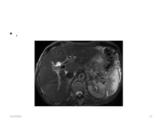 Splenic Rupture Mri splenic trauma imaging modalities. .pptx