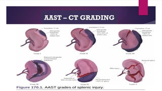 AAST – CT GRADING
 