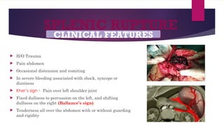 SPLENIC RUPTURE
 H/O Trauma
 Pain abdomen
 Occasional distension and vomiting
 In severe bleeding associated with shock, syncope or
dizziness
 Kher’s sign Pain over left shoulder joint
 Fixed dullness to percussion on the left, and shifting
dullness on the right (Ballance’s sign).
 Tenderness all over the abdomen with or without guarding
and rigidity
CLINICAL FEATURES
 