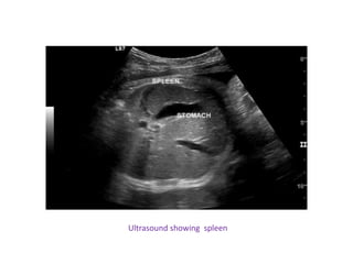Ultrasound showing spleen
 