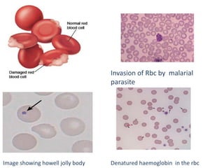 Invasion of Rbc by malarial
parasite
Image showing howell jolly body Denatured haemoglobin in the rbc
 