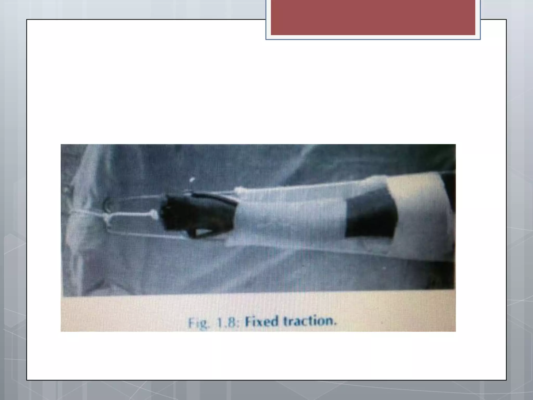 Splint and tractions | PPTX