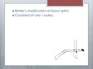  Bohler’s modification of braun splint.
 Consisted of only 1 pulley.
 