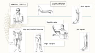 HANGING ARM CAST SHORT ARM CAST
Short leg cast
One and one-half hip-spica
Single hip-spica
Shoulder spica
Long leg cast
 