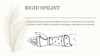 RIGID SPILINT
– A rigid splint can be used to immobilize a fracture or dislocation in an extremity,
as shown at right. Ideally, two people should apply a rigid splint to an extremity.
 