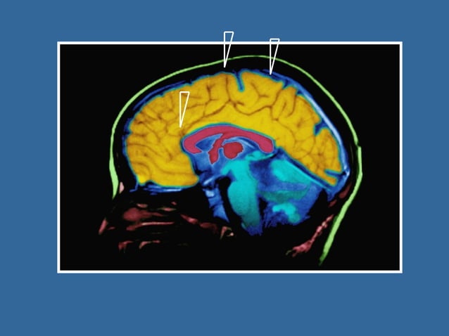 Splinter Negotiation Technique | PPT