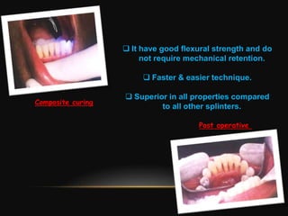 Splinting of teeth in periodontics | PPTX