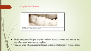 Acrylic Full Crowns
• Fixed temporary bridges may be made of acrylic crowns and pontics and
may also serve as temporary splints.
• They are used when permanent fixed splints will ultimately replace them.
 