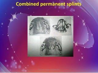 Permanent Splints Splinting | PPTX