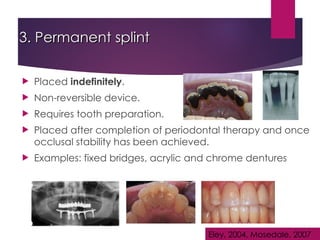 3. Permanent splint
3. Permanent splint
 Placed indefinitely.
 Non-reversible device.
 Requires tooth preparation.
 Placed after completion of periodontal therapy and once
occlusal stability has been achieved.
 Examples: fixed bridges, acrylic and chrome dentures
Eley, 2004, Mosedale, 2007
 