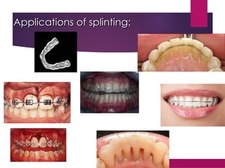 Applications of splinting:
Applications of splinting:
 