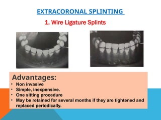 Essig Splinting Splinting of teeth in human oral cavity. | PPTX