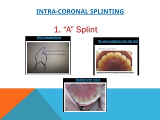 Splinting Humor Splinting of teeth in human oral cavity. | PPTX