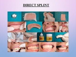 SPLINTING-MATERIALS AND TECHNIQUES final.pptx
