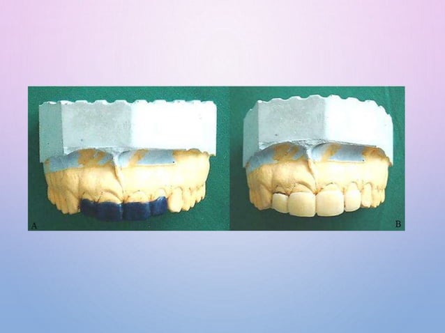 Splinitng Incision SPLINTING-MATERIALS AND TECHNIQUES final.pptx