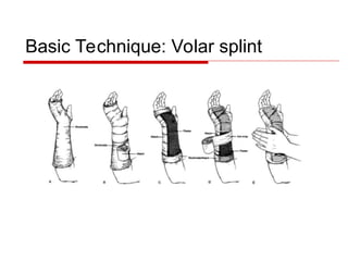 Splinting-Techniques for Orthopaedic Residency | PPT