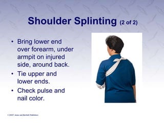 Shoulder Splinting (2 of 2)
• Bring lower end
over forearm, under
armpit on injured
side, around back.
• Tie upper and
lower ends.
• Check pulse and
nail color.
 