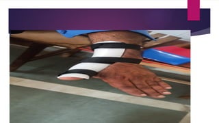 Splinting Def SPLINTING by Dk.pptx.................... | PPTX