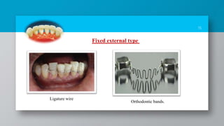 15
Fixed external type
Ligature wire
Orthodontic bands.
 