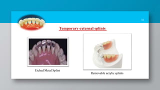 18
Temporary external splints
Etched Metal Splint
Removable acrylic splints
 