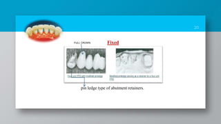 20
pin ledge type of abutment retainers.
Fixed
FULL CROWN
 