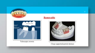 21
Removable
Telescopic crowns
Clasp supported partial denture
 