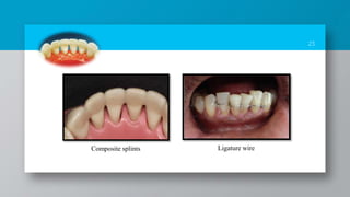 23
Composite splints Ligature wire
 