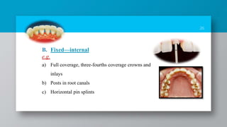 26
B. Fixed—internal
e.g.
a) Full coverage, three-fourths coverage crowns and
inlays
b) Posts in root canals
c) Horizontal pin splints
 